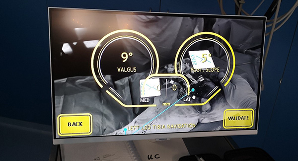 Bein-Achskontrolle für die richtige Schnittführung bei Knie-TEP (zusätzliche Kontrolle am Monitor)