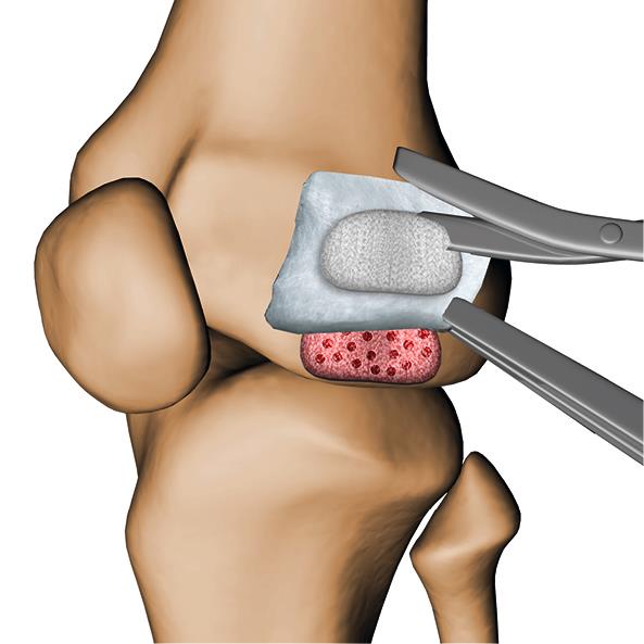 Biologische Matrix zur Knorpelbildung