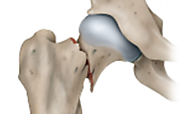 Welche Arten von Hüftoperationen gibt es? 17
