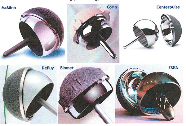 Hüftoberflächenersatz Metall-Metall, verschiedene Prothesenmodelle (2005)