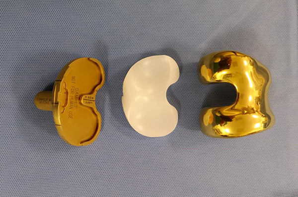 Knieprothese mit Titanlegierung (Tibea-, Inlay- und Femurkomponente)