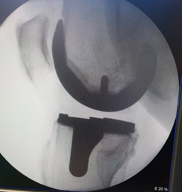Knieprothese nach Implantation (Ansicht seitlich)