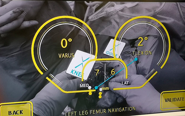 Präzise Ausrichtung bei Implantation einer Knieprothese mittels Augmented Reality Brille