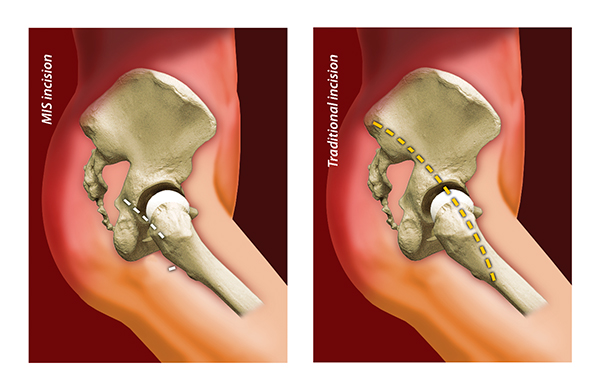 Minimal-invasive Hüftzugänge ermöglichen eine schnellere Mobilisierung