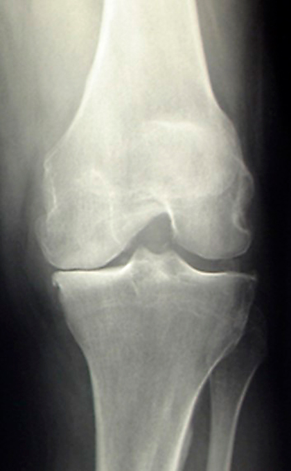 Kniegelenk mit Arthrose auf der Innenseite