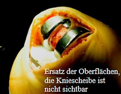 Knieprothese bicondylär