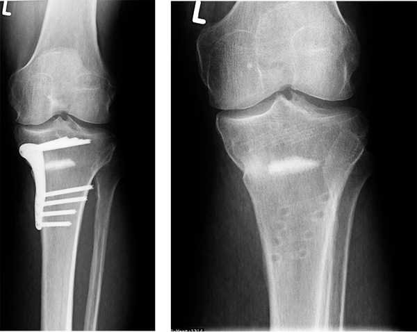 Osteotomie bei Kniearthrose (li. nach Operation, re. nach Metallentfernung)