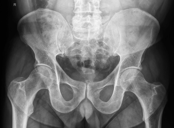  Röntgenbild Beckenübersicht mit beiden Hüftgelenken